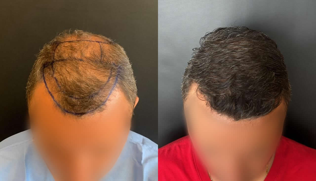 Antes e depois do transplante capilar – caso 5