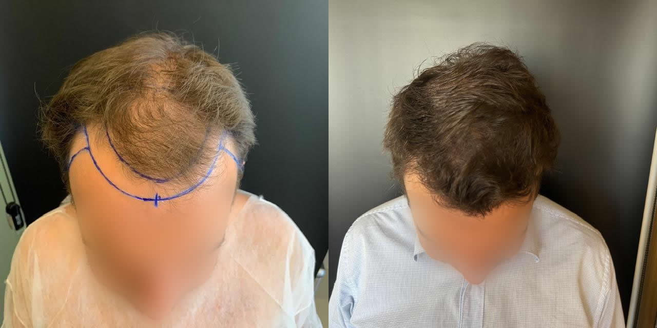 Antes e depois do transplante capilar – caso 6