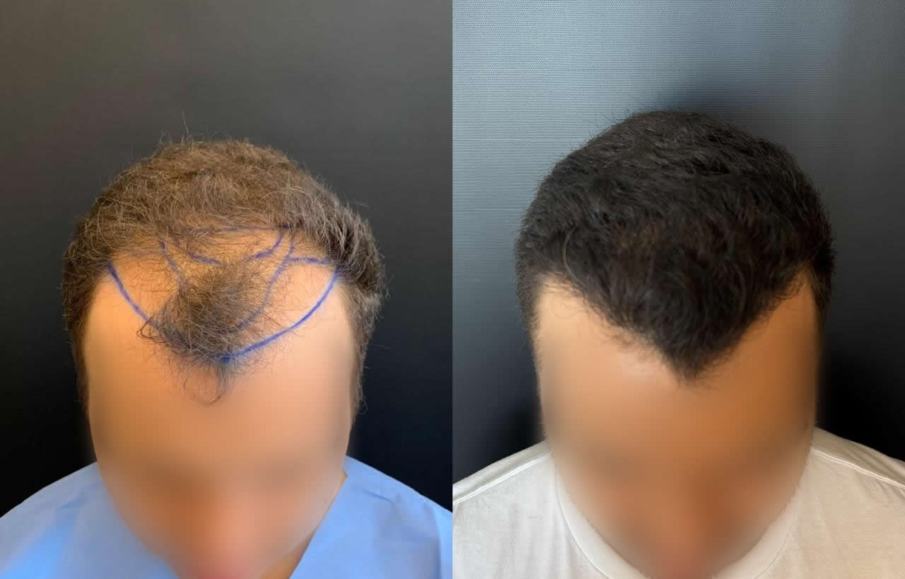 Antes e depois do transplante capilar – caso 7