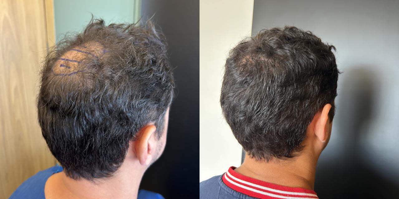 Antes e depois do transplante capilar – caso 9