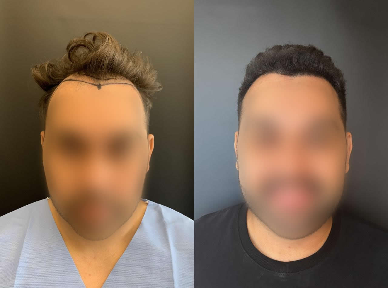 Antes e depois do transplante capilar – caso 10
